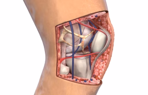 دلایل و روش‌های درمان پارگی تاندون کشکک (Patellar Tendon Tear)