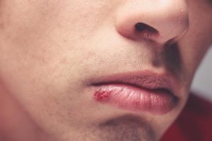 انواع روغن‌های ضروری برای درمان تبخال و زمان مراجعه به پزشک