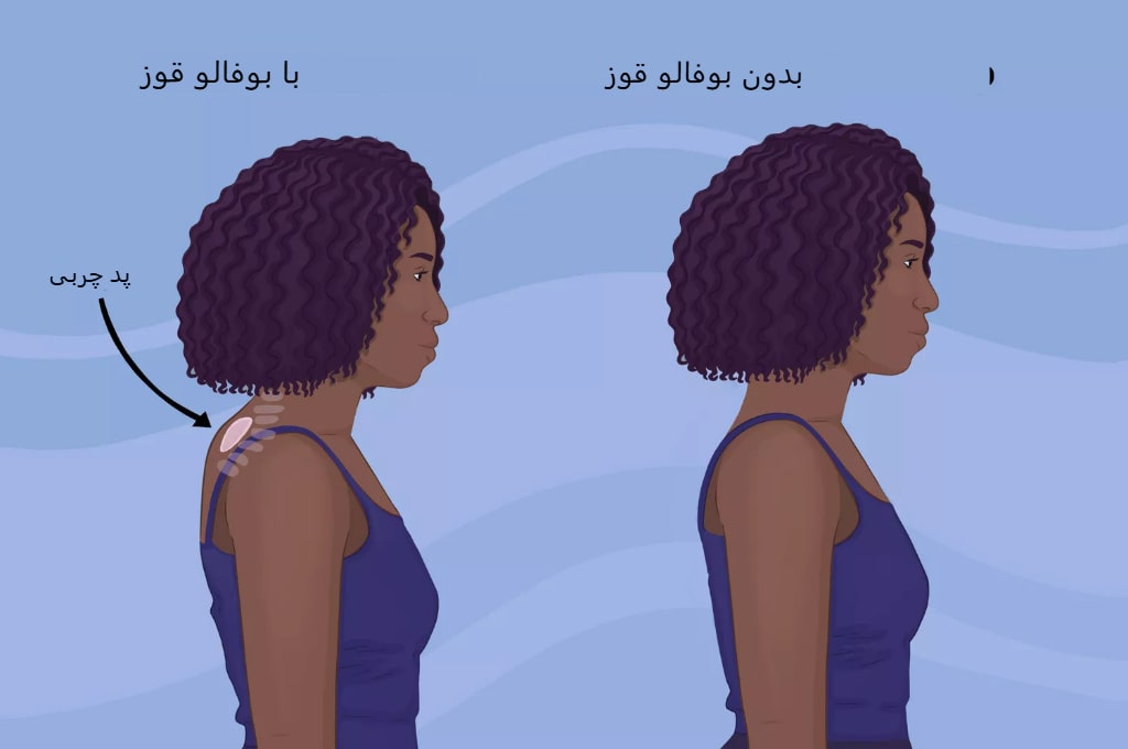 راهنمای خلاص شدن از قوز بوفالو (تجمع چربی پشتی گردنی)