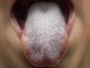 آیا می توان درمرحله 4 سرطان روده بزرگ به بهبودی رسید؟