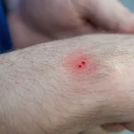 نحوه تشخیص علائم گزش مار