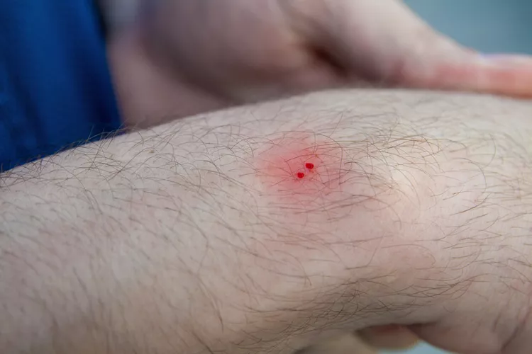 نحوه تشخیص علائم گزش مار