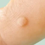 علائم و تشخیص ویروس پاپیلومای انسانی (HPV)