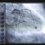 کاتتریزاسیون قلبی (Cardiac Catheterization) چیست؟ (ارزیابی و درمان بیماری‌های قلبی)