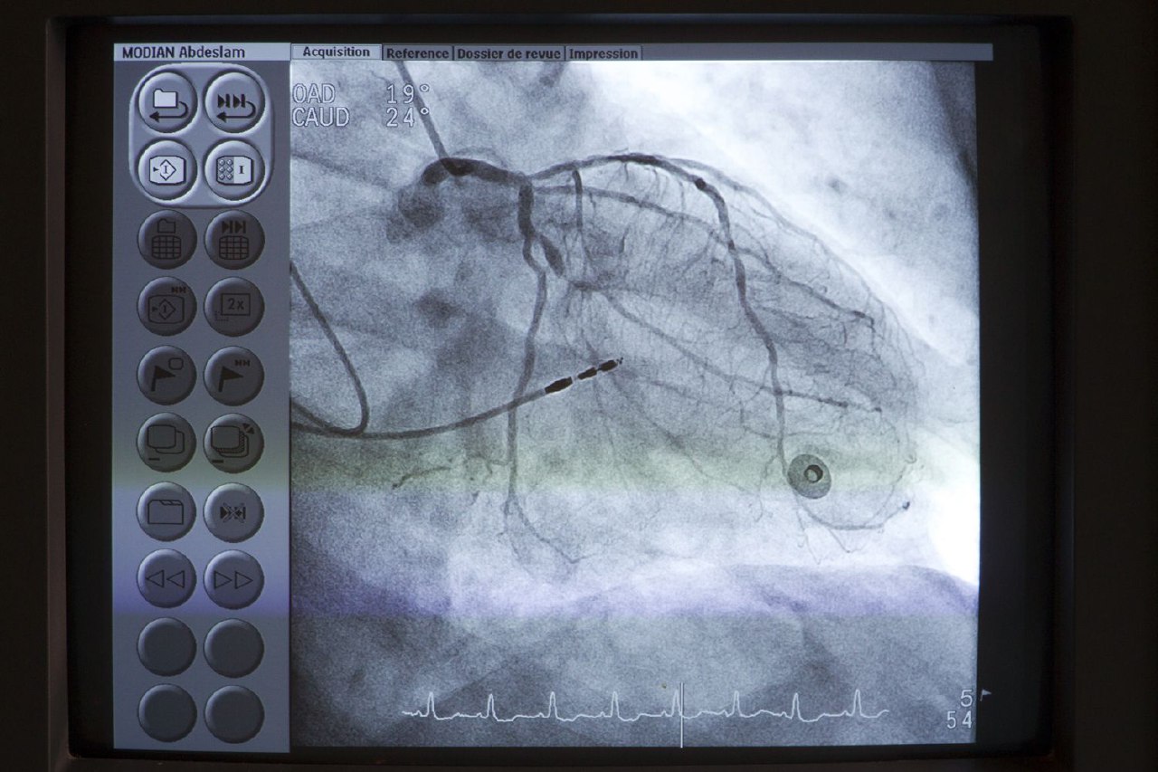 کاتتریزاسیون قلبی (Cardiac Catheterization) چیست؟ (ارزیابی و درمان بیماری‌های قلبی)