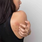 آیا استرس می‌تواند باعث بثورات جلدی یا کهیر شود؟ علائم و درمان‌ها