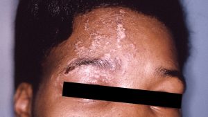 آرتریت پسوریاتیک چیست؟  علائم، علل، تشخیص