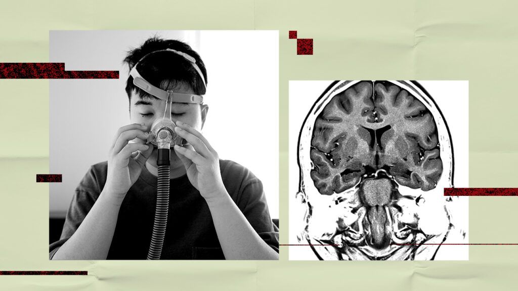 آپنه خواب ممکن است خطر میکروخونریزی مغزی را افزایش داده و به زوال عقل یا سکته مغزی منجر شود