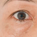 آنچه پف اطراف چشم می‌تواند درباره سلامت شما آشکار کند