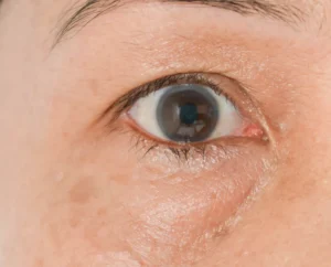 آنچه پف اطراف چشم می‌تواند درباره سلامت شما آشکار کند