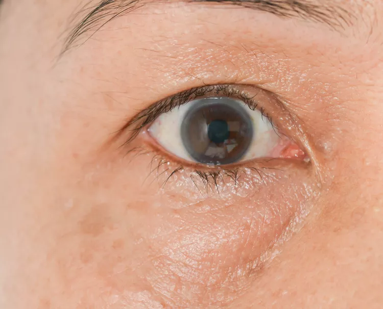 آنچه پف اطراف چشم میتواند درباره سلامت شما آشکار کند
