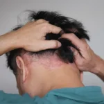 انواع داروهای درمانی پسوریازیس پوست سر: راهنمای جامع