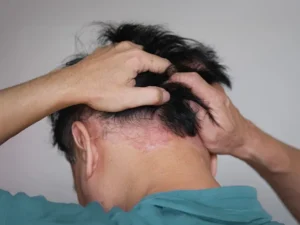 انواع داروهای درمانی پسوریازیس پوست سر: راهنمای جامع