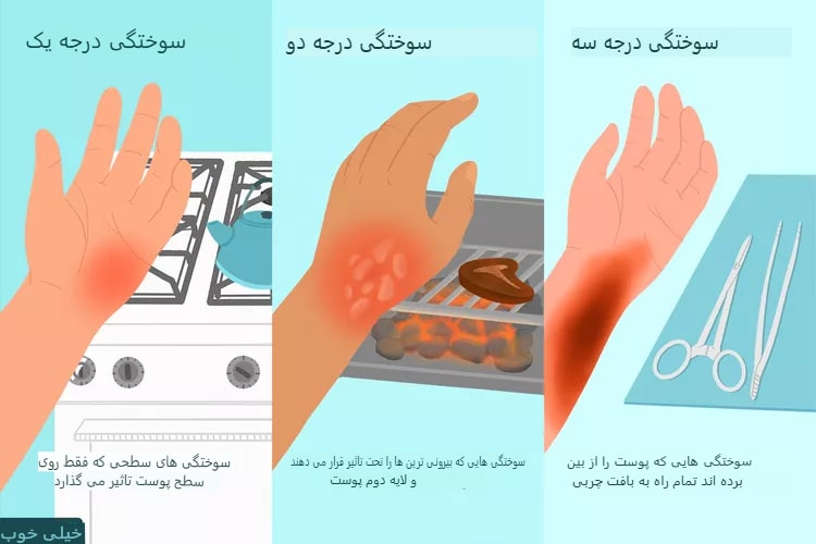 اقدامات اولیه ضروری کمکهای اورژانسی برای انواع سوختگیها