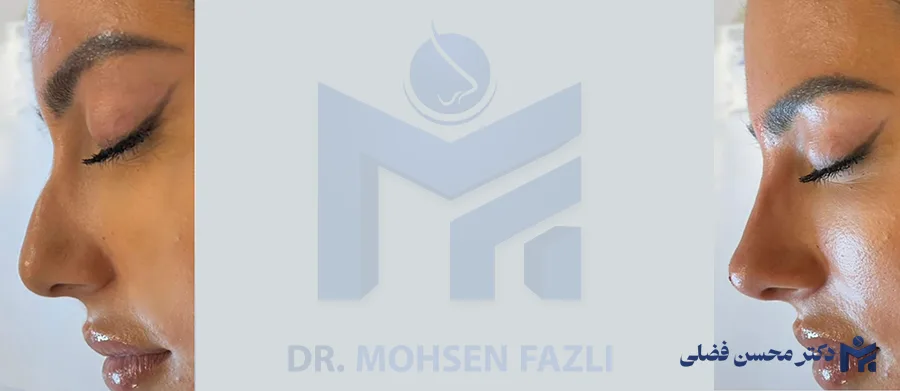 قوس بینی طبیعی و فانتزی