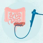 سیگموئیدوسکوپی چیست و چرا انجام می‌شود؟