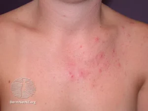 چگونه آکنه قارچی را تشخیص دهیم و درمان کنیم؟