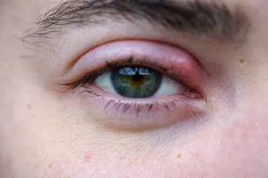 گل‌مژه چیست؟ علل، علائم و بهترین روش‌های درمان و پیشگیری