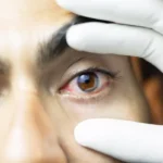 راهنمای جامع تشخیص و درمان انواع التهاب ملتحمه (Pink Eye)