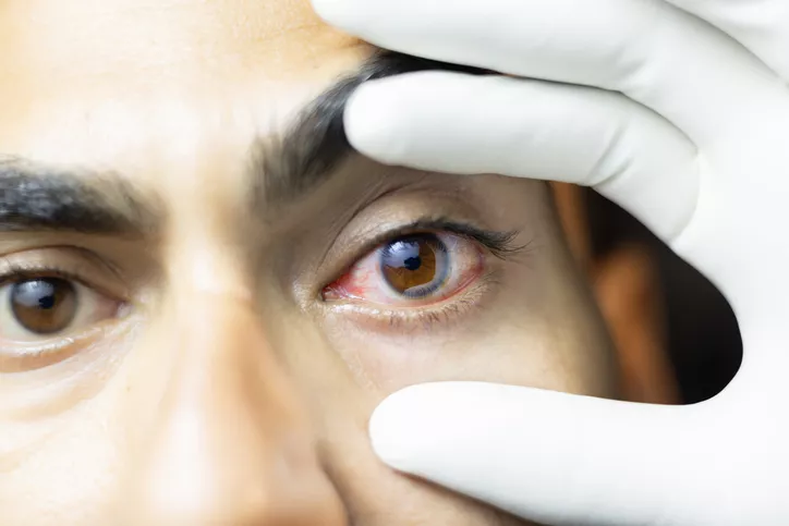 راهنمای جامع تشخیص و درمان انواع التهاب ملتحمه (Pink Eye)