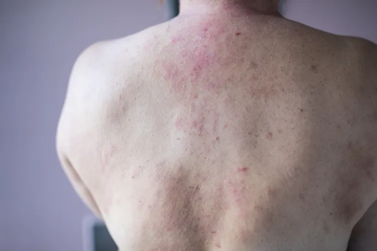 چرا برخی افراد دچار کهیر مزمن یا کهیر خودبهخودی مزمن میشوند؟