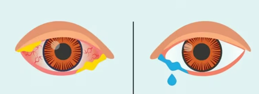 چشم صورتی (Pink Eye) یا آلرژی: کدام را دارید؟