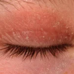 چگونه درماتیت پلک را تشخیص دهیم و به‌درستی درمان کنیم؟