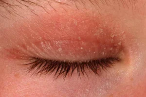 چگونه درماتیت پلک را تشخیص دهیم و به‌درستی درمان کنیم؟
