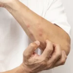 چگونه خارش نیش حشرات را بدون خاراندن آرام کنیم؟