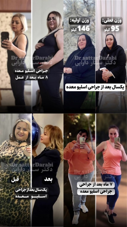 عکس قبل و بعد اسلیو معده توسط دکتر ستار دارابی