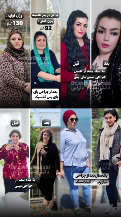 عکس قبل و بعد بای پس معده توسط دکتر ستار دارابی