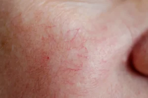 علت نمایان شدن رگ‌های صورت چیست و چگونه درمان می‌شود؟