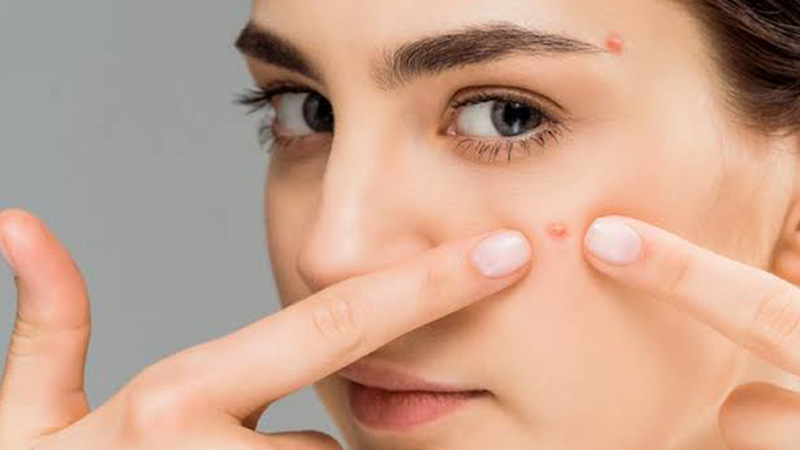 چرا بعد از فیشال صورت جوش می‌زنیم؟