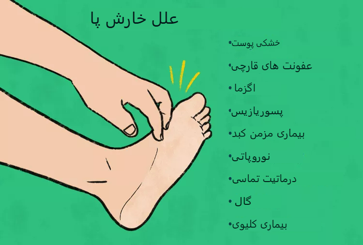 خارش کف و روی پا؛ دوازده علت شایع و روش‌های مؤثر برای تسکین آن