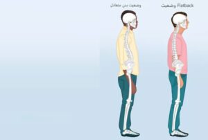 سندروم کمر صاف چیست؟ علائم، علل، تشخیص و درمان